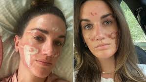 Denuncia a esteticista de famosos por haberle "desfigurado" el rostro de  manera permanente