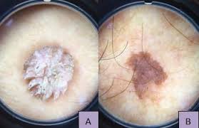 Image result for verrucae filiformes