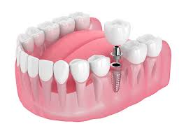 Dental Implants