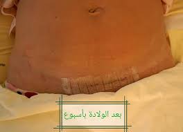 الخياطة التجميلية بالصور