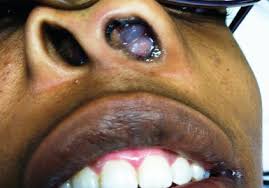 The majority of people with nasal polyps will experience nasal congestion, which may be severe and unable to be helped by typical allergy medications. Antrochoanal Polyp Consultant360