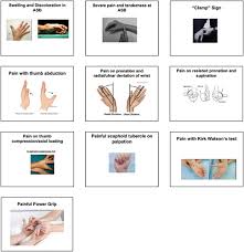 Image result for Scaphoid Fracture Signs