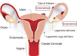 The lining is called the endometrium. Endometriosi Non E Un Semplice Dolore Studio Kea