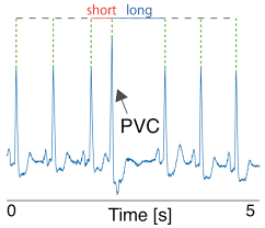 Image result for Extrasystole