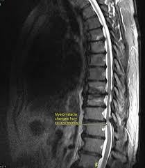 Mri and ultrasound have been utilised in the assessment of the plantar intrinsic foot muscles. Worsening Leg Weakness And A Negative Lumbar Mri