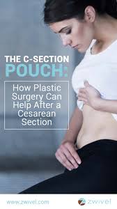 The C Section Pouch How Plastic Surgery Can Help After A Cesarean Section C Section Pouch C Section Mommy Makeover Surgery