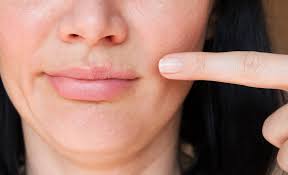 Check spelling or type a new query. Angular Cheilitis Luka Di Sudut Bibir Penyebab Dan Pengobatan