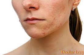 Assalamualaikum.hi hari ni sy nak share cara nak hilangkan kesan parut akibat jerawat dan melicinkan kulit wajah.bahan yg korang kena ada.1. Cara Menghilangkan Parut Jerawat Yang Mendalam