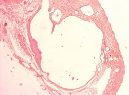 Maybe you would like to learn more about one of these? Retroperitoneal Approach For Recurrent Benign Multicystic Peritoneal Mesothelioma Abstract Europe Pmc
