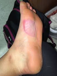 The other main difference between foot and finger blood blisters is our feet are generally a more germy environment, and so they're more susceptible to infection. These Blisters Will Haunt Your Nightmares Runner S World