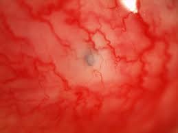 Image result for Conjunctival Foreign Body