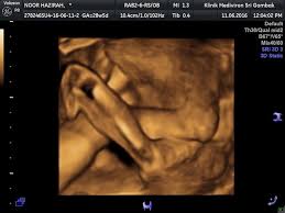 We did not find results for: I Am A Mother Of Two Scan 3d Bersama Dr Siti Klinik Mediviron Sri Gombak