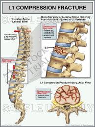 Lumbar Spine L1 Compression Fracture Trial Exhibit Stock Trial Exhibits