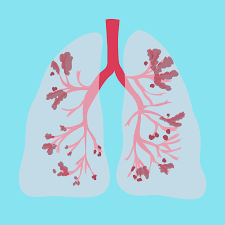 What is chronic obstructive pulmonary disease? Chronic Obstructive Pulmonary Disease Copd Overview And More