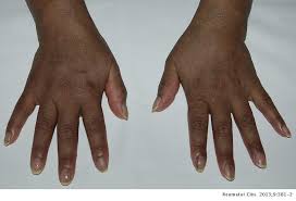 Hiperpigmentacion Cutanea Generalizada Y Melanoniquia Longitudinal Secundarias Al Tratamiento Con Hidroxicloroquina En Lupus Eritematoso Sistemico Reumatologia Clinica