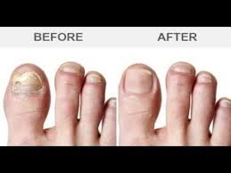 Benefits of using tea tree oil to combat toenail fungus. How To Get Rid Of Toenail Fungus With Tea Tree Oil