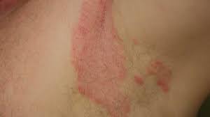 Inverse Psoriasis Or Jock Itch Which Is It A rashes are seen on the groin, skin folds, buttocks or inner thighs. inverse psoriasis or jock itch which