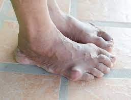 We did not find results for: Got Gout Here S What To Eat And Avoid