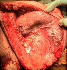 Fournier gangrene is a type of gangrene characterized by the necrosis of cells around the penis. A Contemporary Case Series Of Fournier S Gangrene At A Swiss Tertiary Care Center Can Scoring Systems Accurately Predict Mortality And Morbidity World Journal Of Emergency Surgery Full Text
