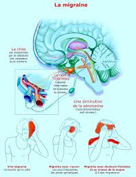 Résultat de recherche d'images pour "Migraine auras"