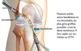Lors de votre entorse du genou, vous avez atteint un ou plusieurs ligaments de l'articulation 2 ligaments croisés, un antérieur et un postérieur, situés au centre de l'articulation. Rupture Croise Dr Remi Chirurgien Orthopediste A Toulouse