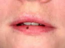 Pin On Black Spots On Lips