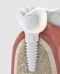Dental implants, sedation dentistry & wisdom teeth removal. Metal Free Dental Implants Replace Your Missing Teeth