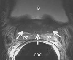 It sits directly beneath your bladder and in front of your rectum. Normal Central Zone Of The Prostate And Central Zone Involvement By Prostate Cancer Clinical And Mr Imaging Implications Radiology