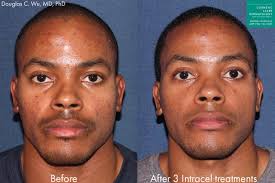 Get all of your questions answered on realself. African American Skin Treatments San Diego Ca Clderm