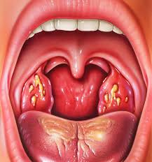 Image result for Tonsillitis