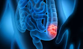 Image result for Colorectal Cancer