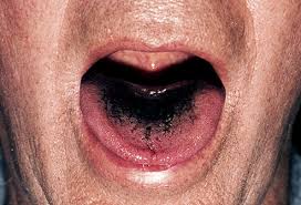 Pictures What Your Tongue Says About Your Health