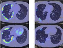 Maybe you would like to learn more about one of these? Fdg Pet Ct Scan A Extensive Nodular Thickening Of The Right Pleura At Download Scientific Diagram