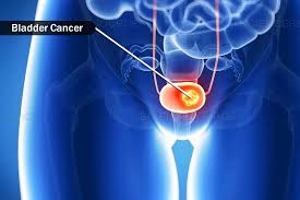 Image result for Bladder Cancer