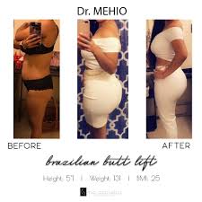 Surgery journey in miami with mia aesthetics. Mia Aesthetics Beautiful Shape By Drmehio Mia Facebook