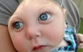 Image result for images of zika babies