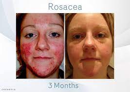 Die erkrankung ist durch einen chronischen und schubartigen verlauf gekennzeichnet und wird durch ein genetisch prädisponiertes, multifaktorielles geschehen bedingt. Learn How To Treat Acne Rosacea Key Differences To Acne