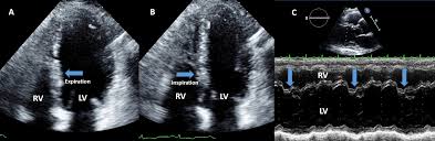 Constrictive pericarditis: diagnosis, management and clinical outcomes