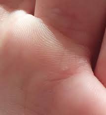 Ist Das Eine Warze An Der Hand Gesundheit Und Medizin Medizin Haut