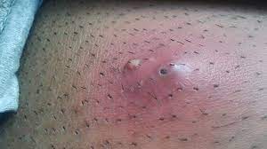 These bumps can contain pus, which may sometimes signify an infection that doctors call folliculitis. Ingrown Hair Cyst Symptoms Treatment Prevention More