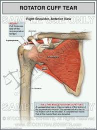 Rotator Cuff Full Thickness Tear Of The Right Shoulder Rotator Cuff Rotator Cuff Tear Tinnitus Symptoms