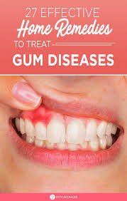 8 Natural Remedies To Treat Gum Disease In 2020 Gum Disease Remedies Home Remedies