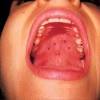 Bumps or lumps on the roof of the mouth can also be a result of sexually transmitted diseases such as hiv and oral herpes. 1