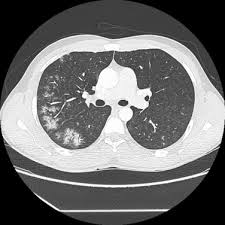 Les infos, chiffres, immobilier, hotels & le mag. Hemorragie Intra Alveolaire Sciencedirect
