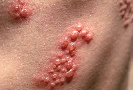 During the first phase that lasts about 3 days, the skin breaks out in red bumps. Andi Rosnita Berkata Kayap Aka Shingles
