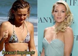 Maybe you would like to learn more about one of these? Kate Hudson Plastic Surgery Before And After Nose Job Breast Implants Plastic Surgery Hits
