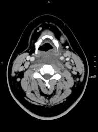 Image result for phlegmon on face)