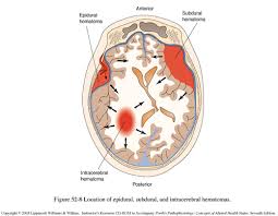 Image result for Brain Contusion