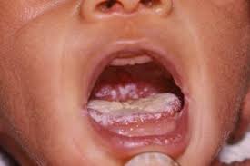 More images for normal roof of mouth toddler » Oral Thrush Mouth Thrush Nhs