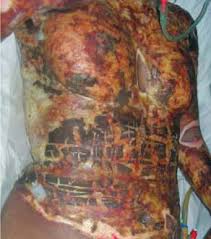 This burn educational video describes indications and technical aspects of escharotomy. Jaypeedigital Ebook Reader